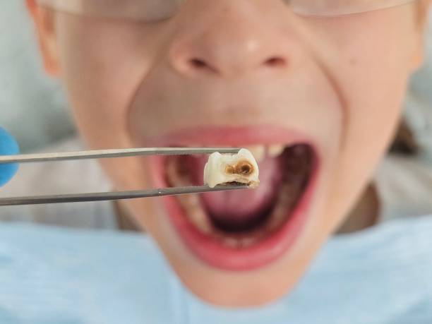 Best Emergency Treatment for Dental Infections or Abscesses in South Sioux City, NE